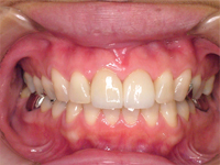 CASE02：歯周治療（レーザー治療）＋ホワイトニング＋前歯2本のオールセラミック治療