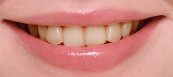 CASE01：ホワイトニング＋上の前歯2本のオールセラミック治療
