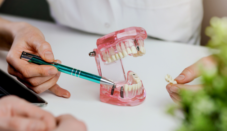 インプラント治療とは