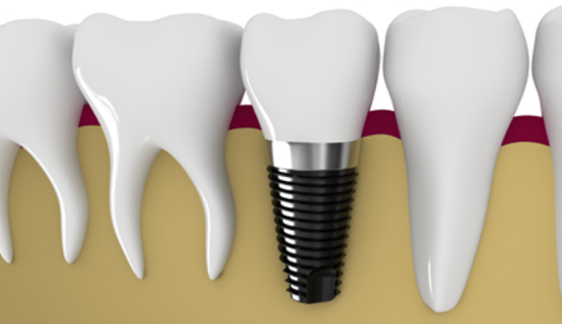 3. 信頼性の高いメーカーのインプラントを選ぶこと