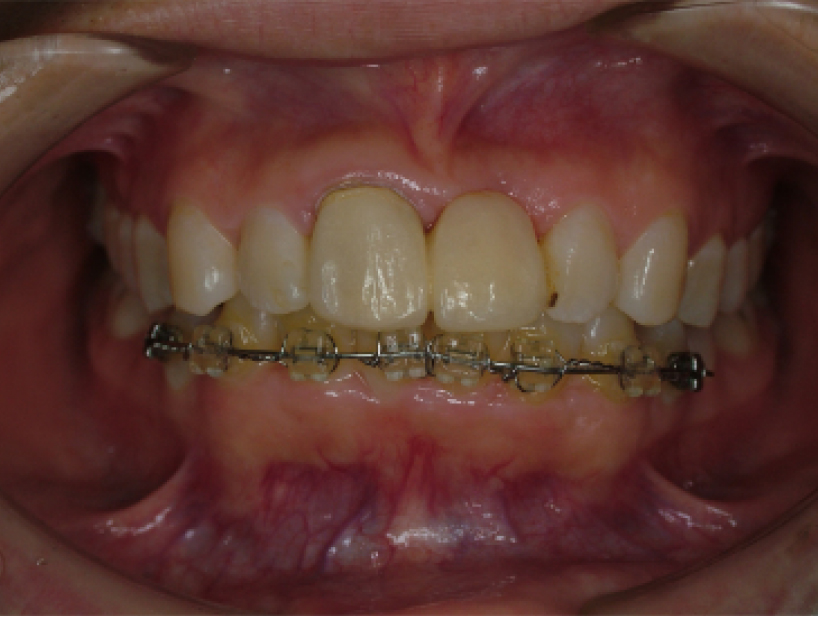 【症例1】前歯インプラント治療／下前歯矯正治療