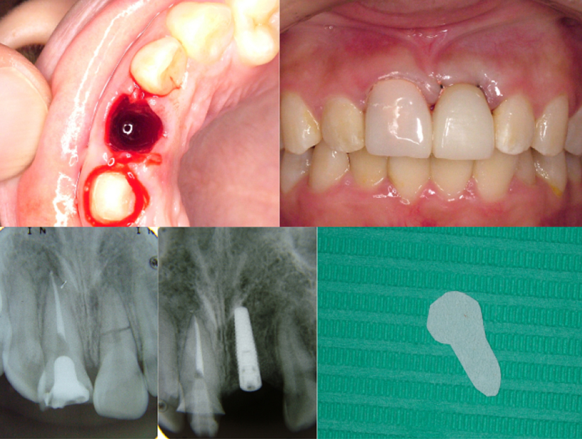 【症例1】前歯インプラント治療／下前歯矯正治療