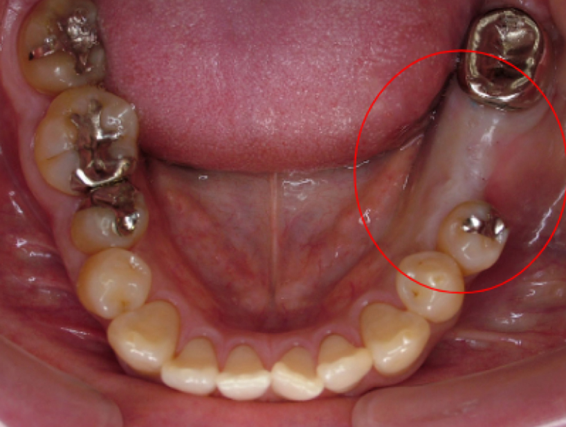 【症例2】インプラント奥歯1本