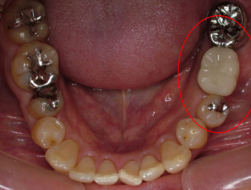 【症例2】インプラント奥歯1本