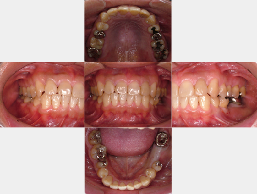 【症例2】インプラント奥歯1本
