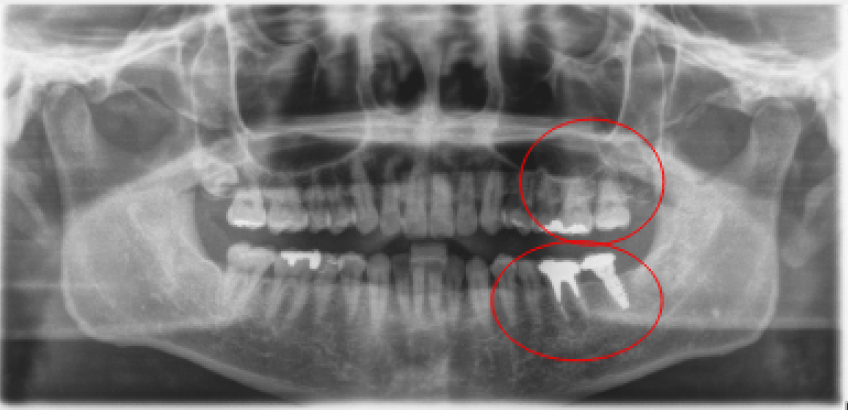 【症例3】インプラント奥歯1本・根管治療・矯正治療（圧下）