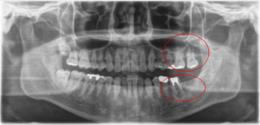 【症例3】インプラント奥歯1本・根管治療・矯正治療（圧下）