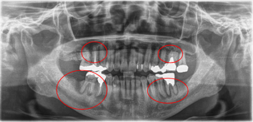 【症例4】インプラント奥歯1本・根管治療6歯