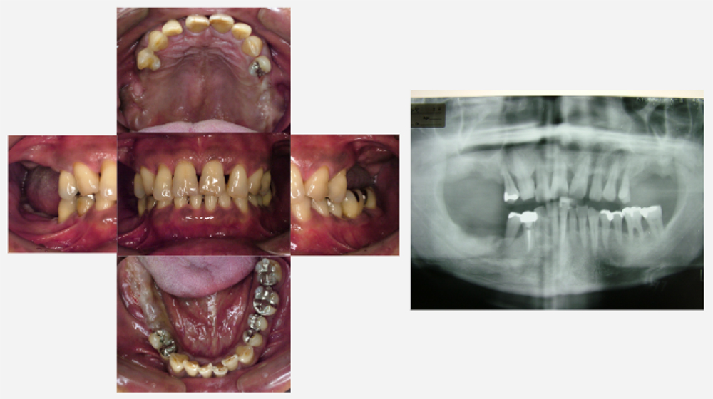 2008年06月　歯周基本治療終了後