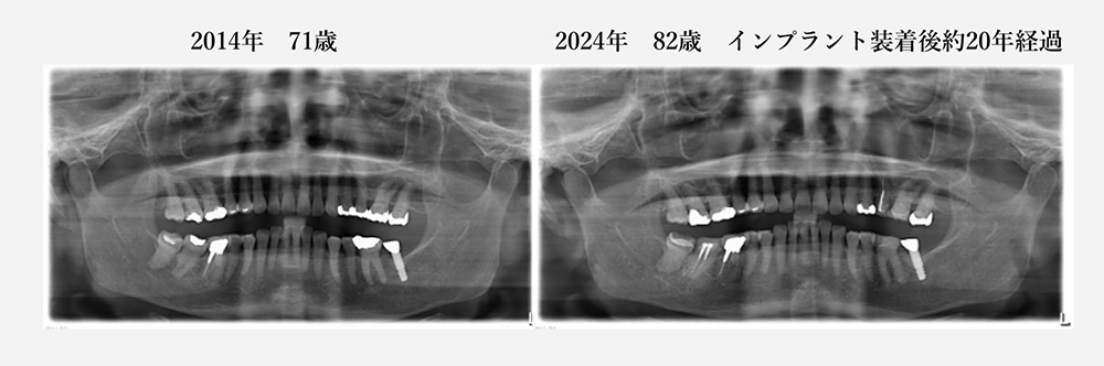現在82歳の女性