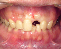 CASE01：ジルコニアアバットメントを使ったインプラント治療