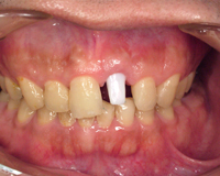 CASE01：ジルコニアアバットメントを使ったインプラント治療