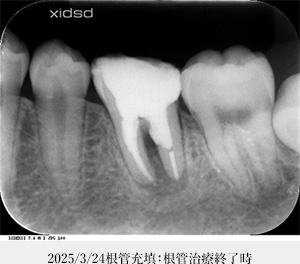 【症例4】感染根管治療