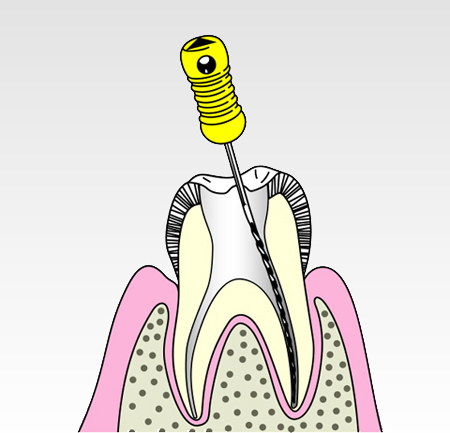 重度の虫歯を治す方法～根管治療（歯内療法）～