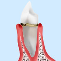 歯肉炎・軽度歯周炎