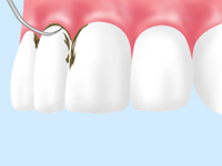 歯肉炎・軽度歯周炎