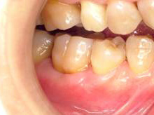 歯周組織再生治療