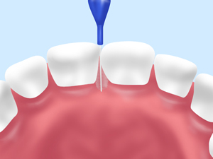 歯間ブラシ